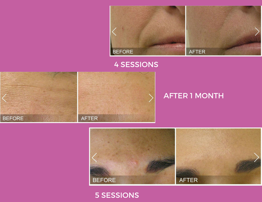 Hydrafacial & Dermaplaning Kirkwood and Town & Country, MO GINGER BAY